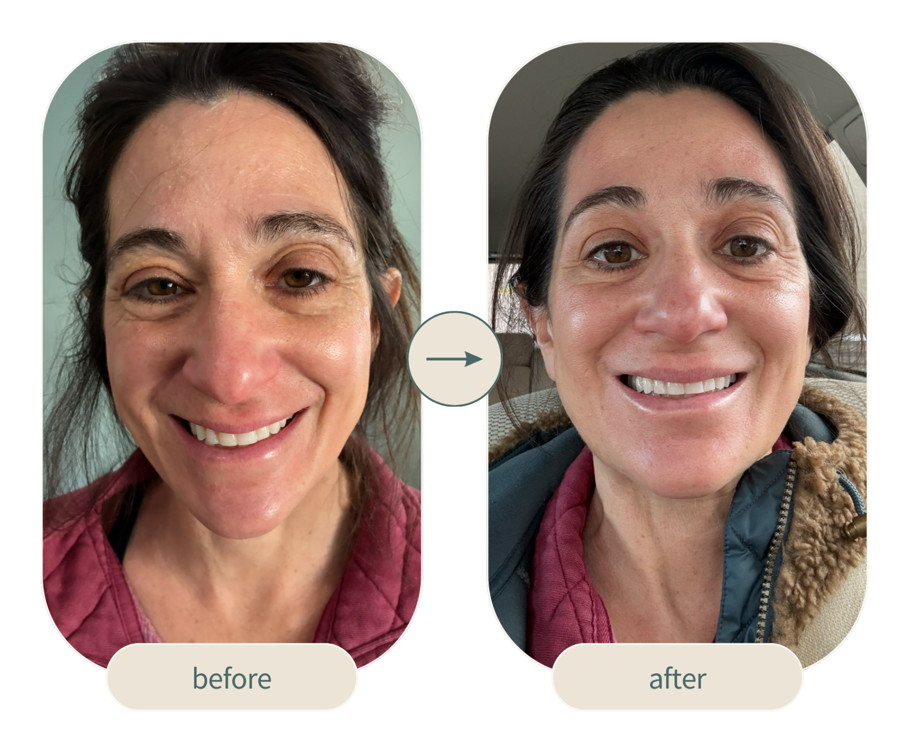 Fotona 4d facelift before & after