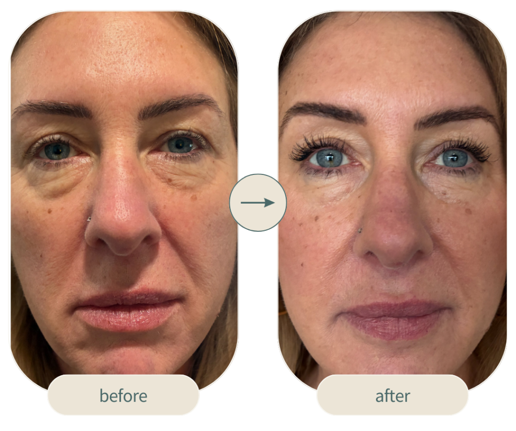 4d face lift before and after