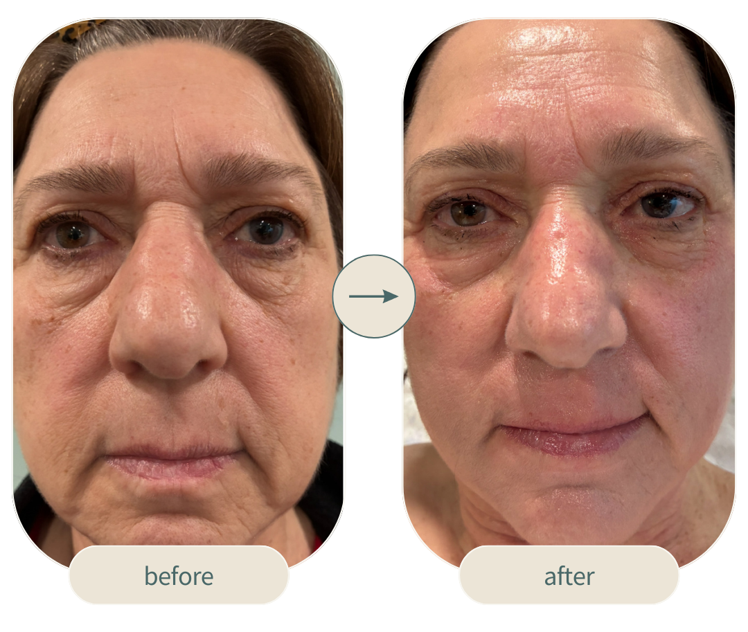 Before and after 4d facelift