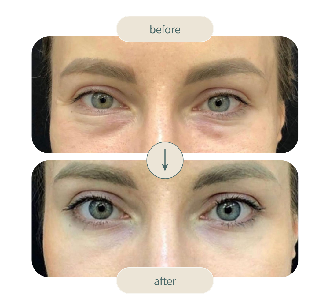 Smooth eye before and after image