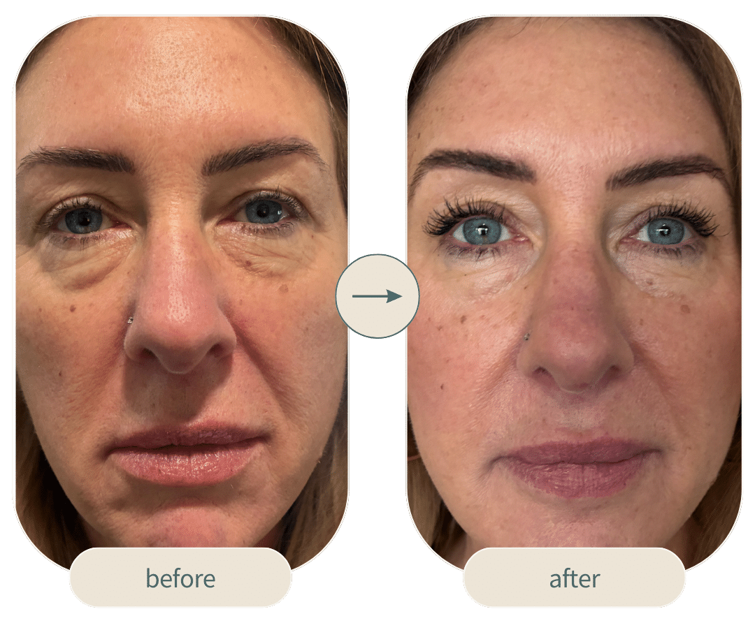Before and After Image: 4D Facelift with Smootheye - front