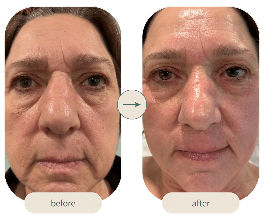 Before and After Image: 4D Facelift with Smootheye and Vector Lift - front