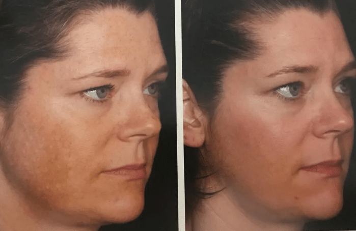 Before and After Image: Jan Marini Chemical Peels - right-side