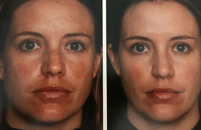 Before and After Image: Jan Marini Chemical Peels - front