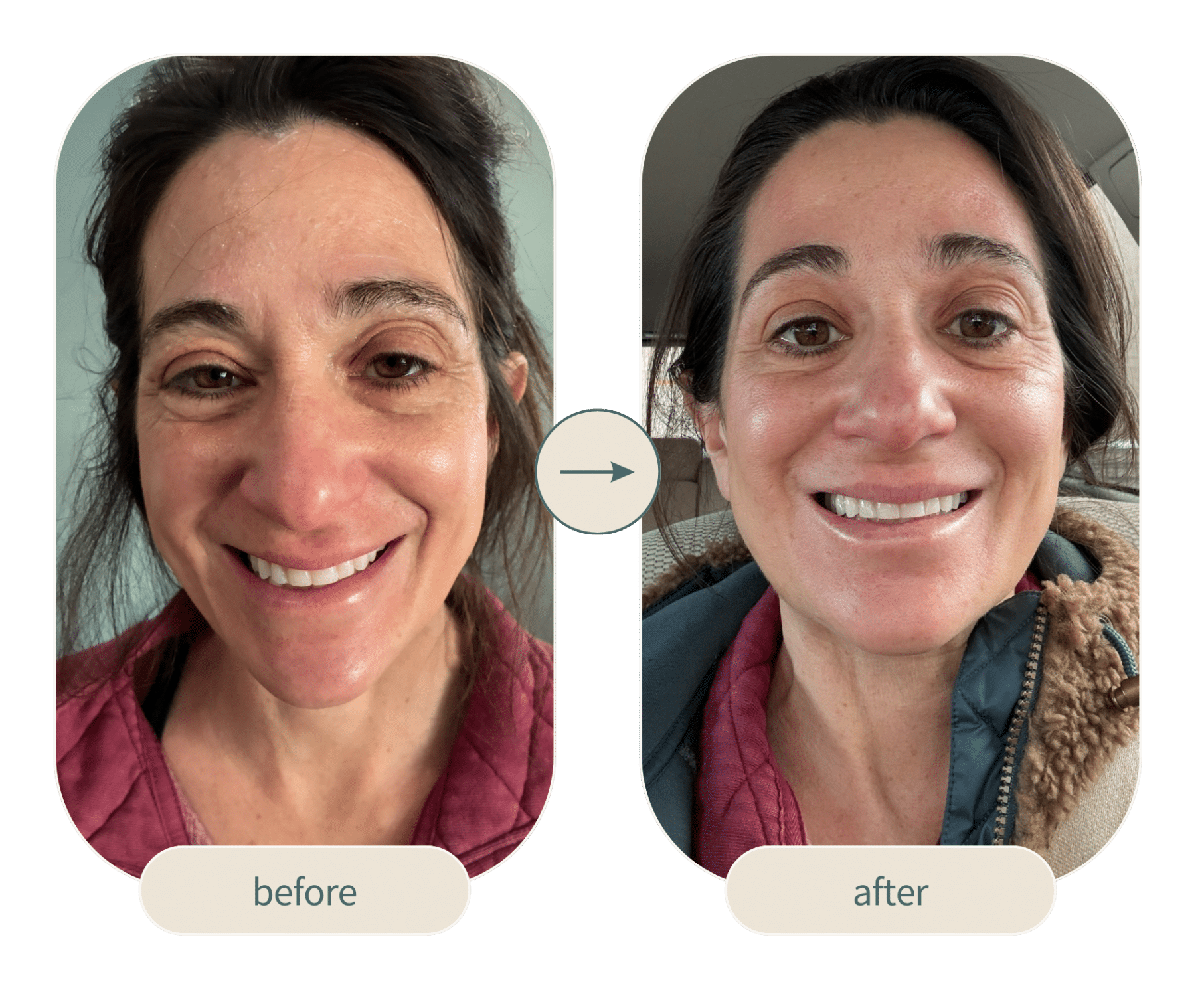 Before and After Image: Fotona 4D - front