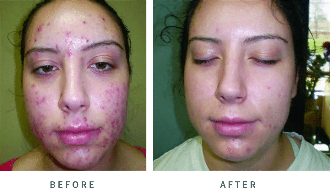 Before and After Image: Laser Acne Facial - front
