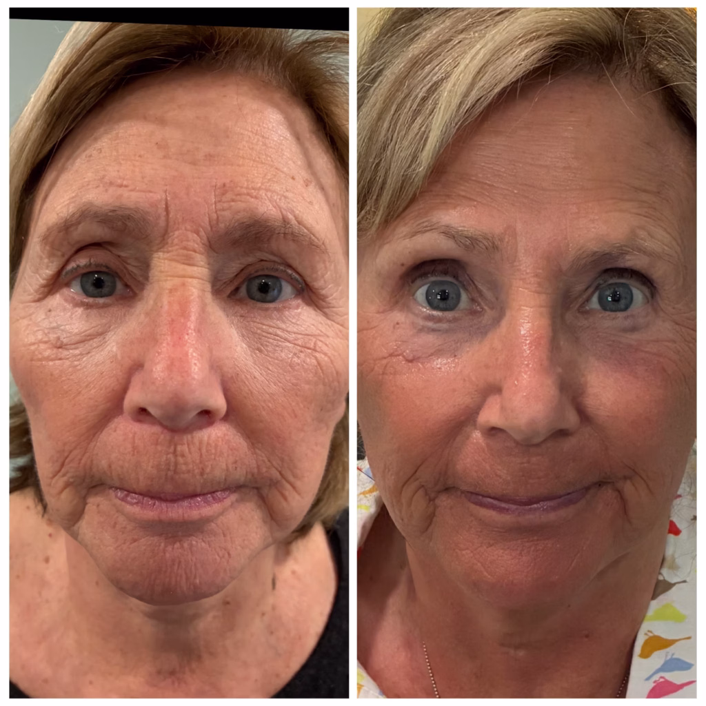 Before and After Image: 4D Facelift - front