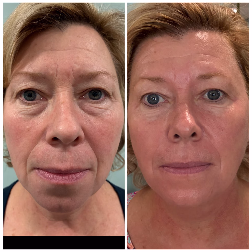 Before and After Image: 4D Facelift - front
