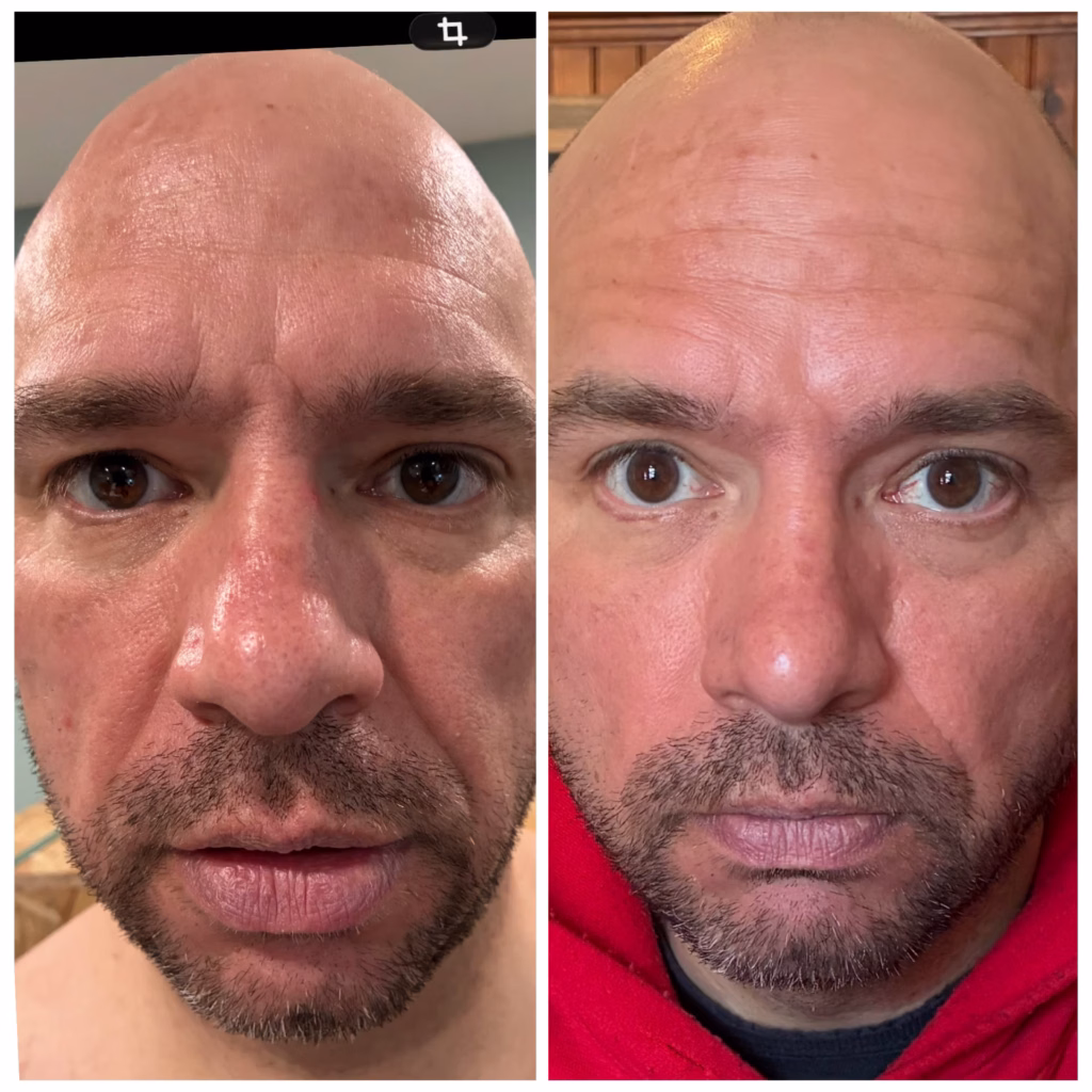 Before and After Image: 4D Facelift - front