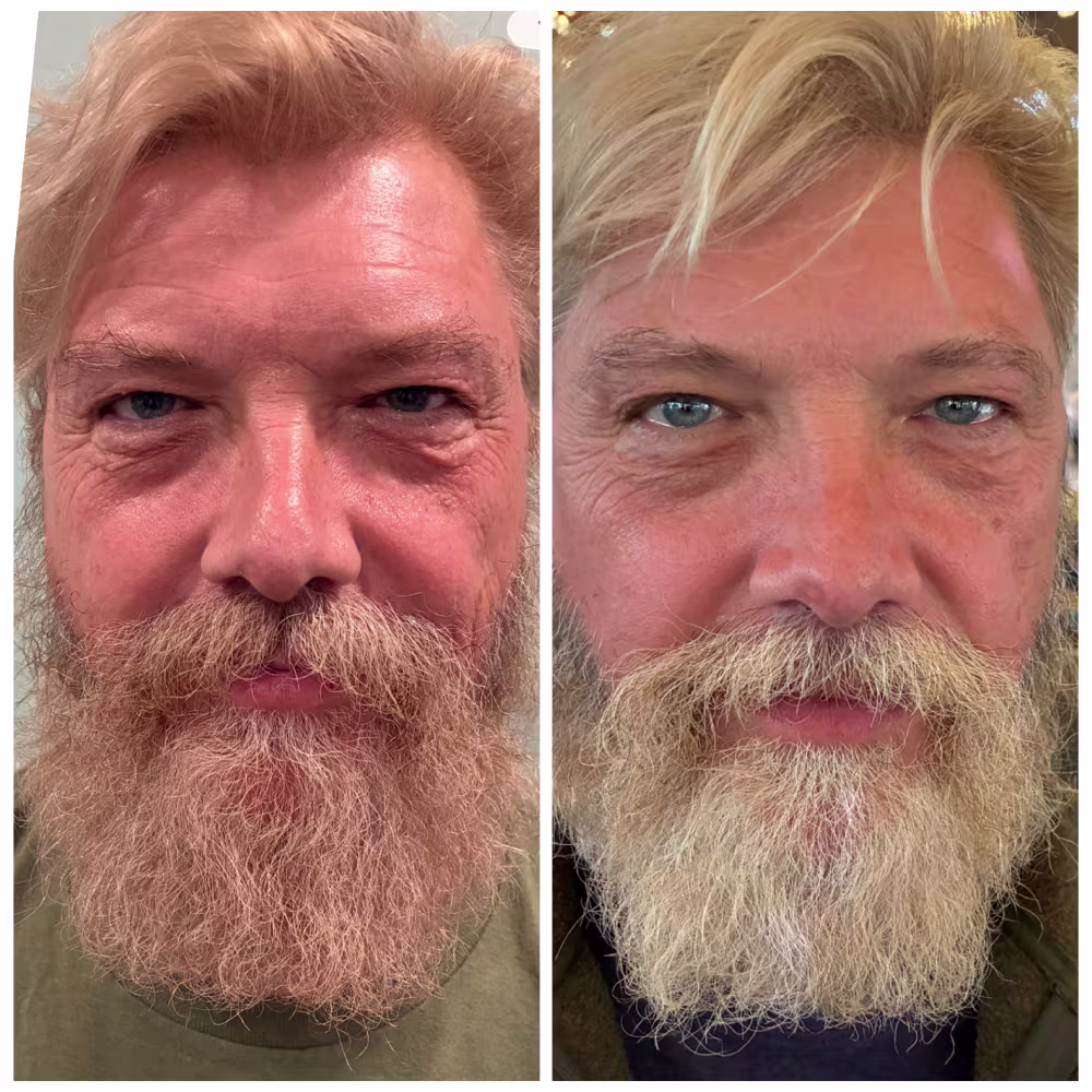 Before and After Image: 4D Facelift - front