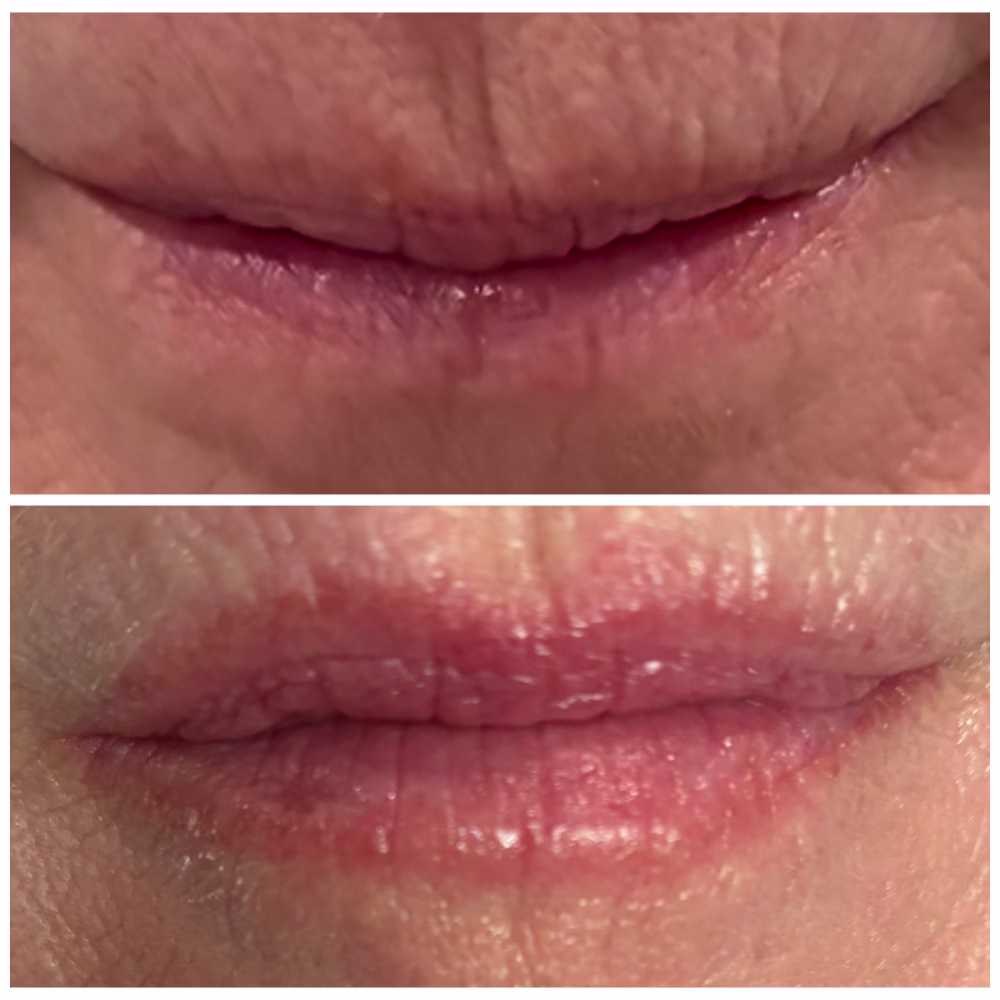 Before and After Image: Liplase - front