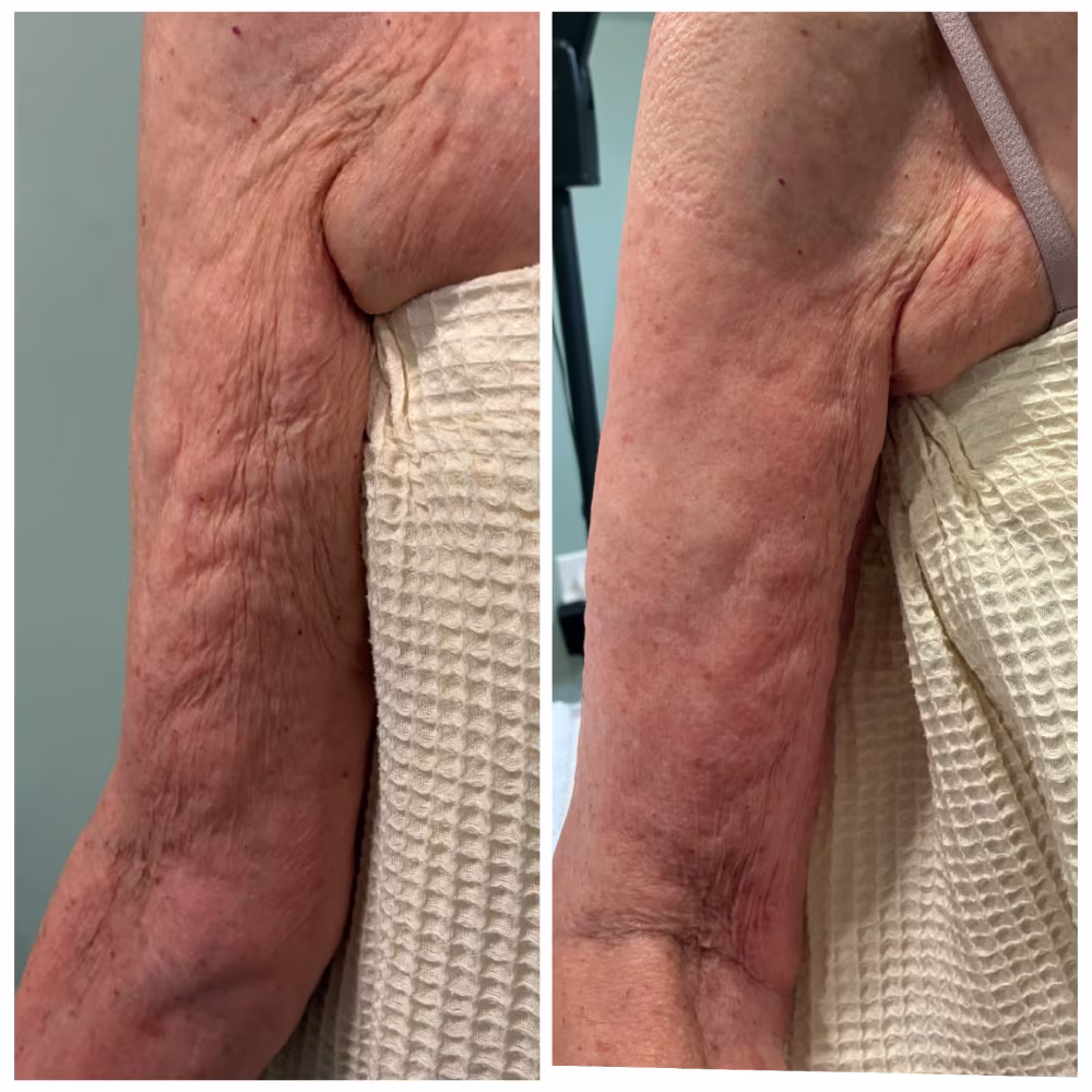 Before and After Image: Tightsculpt - front